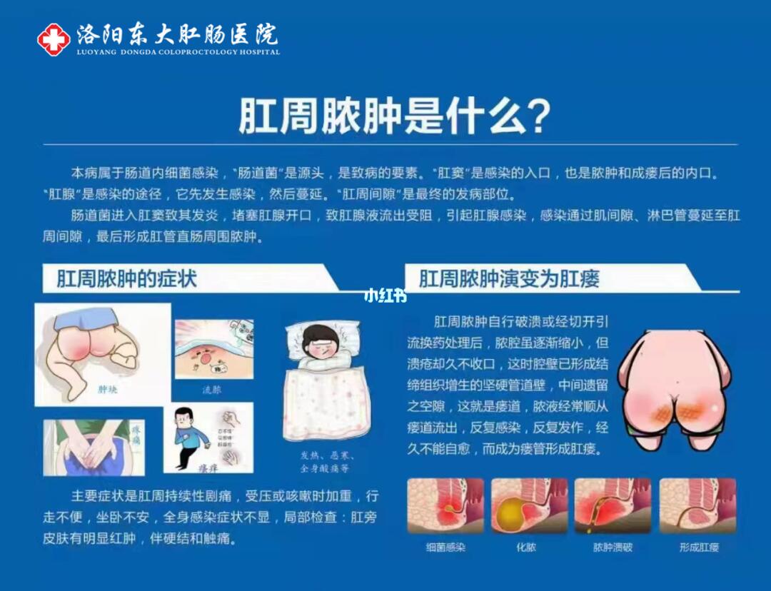 肛周脓肿最新手术方法及其应用研究