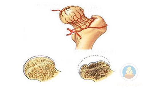 最新股骨头坏死治疗药物研究取得突破性进展