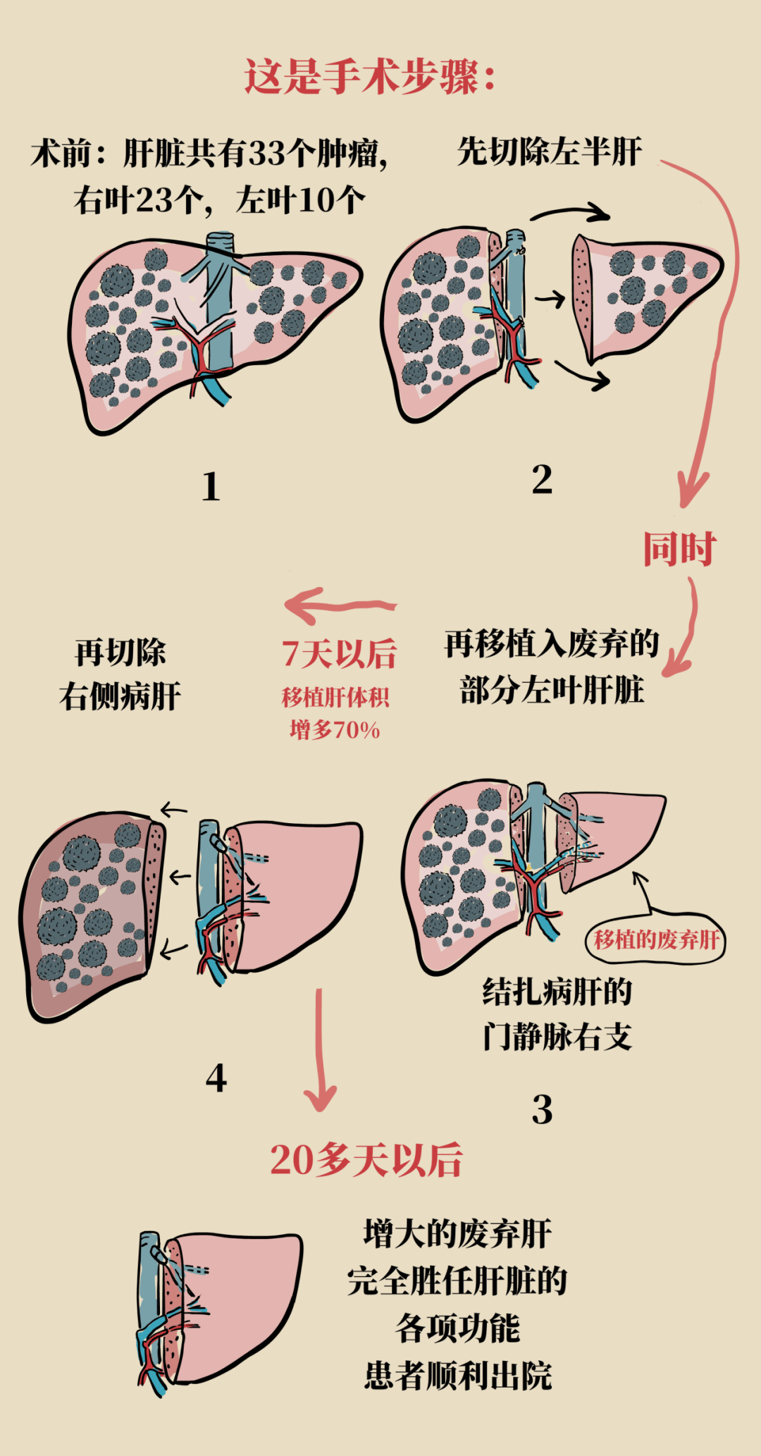 肝癌晚期治疗获重大突破，希望之光照亮生命之路